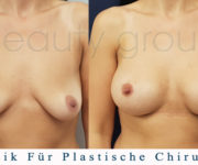 Brustvergrößerung - Bilder vor und nach der Operation - Beauty Group