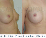 Brustvergrößerung - Bilder vor und nach der Operation - Beauty Group