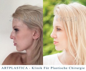 Kinga - nasenkorrektur (rhinoplastik)