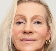 Juvederm Voluma und Botox