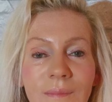 Juvederm Voluma und Botox