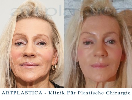 Gerlinde - vor und nach der ästhetischen Behandlung