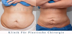 Fettabsaugung (Liposuktion) - Beauty Group - Artplastica