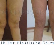 Fettabsaugung-Knie - Artplastica - Beauty Group