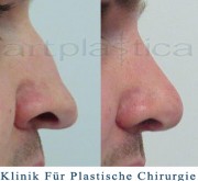 Nasenkorrektur mit Transplantation von Knorpel vom Ohr.