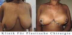Brustverkleinerung -  Bilder vor und nach der Operation