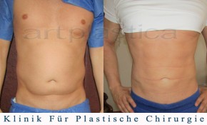 Fettabsaugung (Liposuktion) - Beauty Group - Artplastica