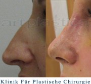 Nasenkorrektur - 10-Tage nach der Operation - Beauty Group - Artplastica