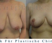 Beauty Group-Artplastica -Brustreduktion - 2 Monate nach der Operation