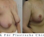 Beauty Group-Artplastica -Brustreduktion - 2 Monate nach der Operation