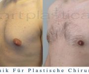 Gynäkomastie - männlich Brustverkleinerung - Bilder vor und nach der Operation - Beauty Group Polen