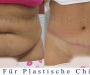 Abdominoplastik - photo 3 Monate nach der Operation - Beauty Group - Polen