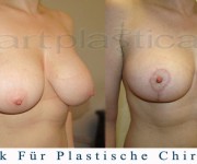 Bruststraffung (nach 2 monaten) - Beauty Group - Artplastica