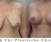 Beauty Group - Artplastica - bruststraffung - einen Monat nach der Operation