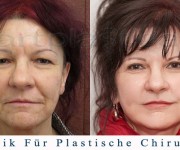 Beauty Group - Artplastica - facelifting, augenliderkorrektur