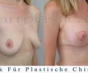 Brustvergroesserung mit brustplastik - 3 Wochen nach der Operation - Beauty Group - Artplastica
