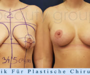 Brustvergroesserung mit brustplastik - Beauty Group