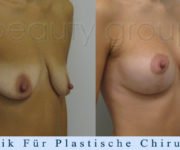 Brustvergroesserung mit brustplastik - 2 Monate nach der Operation - Beauty Group
