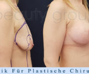 Brustvergroesserung mit brustplastik - Beauty Group