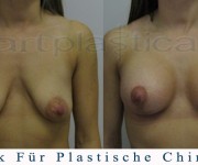 Brustvergroesserung mit brustplastik - Beauty Group - Artplastica