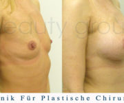 Brustvergrößerung - Bilder vor und nach der Operation - Beauty Group