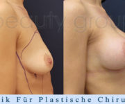 Brustvergrößerung - Bilder vor und nach der Operation - Beauty Group