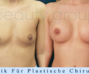 Brustvergrößerung - Bilder vor und nach der Operation - Beauty Group