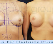 Brustvergrößerung - Bilder vor und nach der Operation - Beauty Group