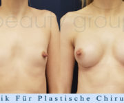 Brustvergrößerung - Bilder vor und nach der Operation - Beauty Group