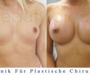 Brustvergrößerung - Bilder vor und nach der Operation - Beauty Group