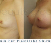 Brustvergrößerung - Bilder vor und nach der Operation - Beauty Group