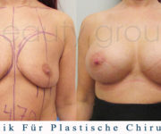 Brustvergrößerung - Bilder vor und nach der Operation - Beauty Group