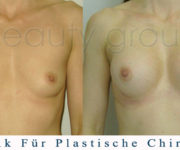 Brustvergrößerung - Bilder vor und nach der Operation - Beauty Group