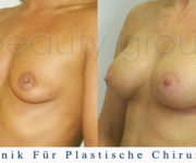 Brustvergrößerung - Bilder vor und nach der Operation - Beauty Group