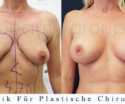 Brustvergrößerung - Bilder vor und nach der Operation - Beauty Group