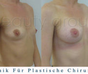 Brustvergrößerung - Bilder vor und nach der Operation - Beauty Group