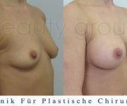 Brustvergrößerung - Bilder vor und nach der Operation - Beauty Group