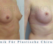 Brustvergrößerung - Bilder vor und nach der Operation - Beauty Group