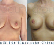 Brustvergrößerung - Bilder vor und nach der Operation - Beauty Group