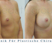 Brustvergrößerung - Bilder vor und nach der Operation - Beauty Group