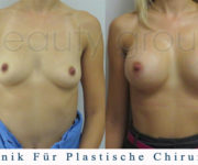 Brustvergrößerung - Bilder vor und nach der Operation - Beauty Group