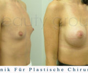 Brustvergrößerung - Bilder vor und nach der Operation - Beauty Group