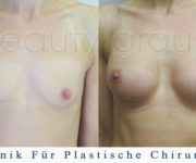 Brustvergrößerung - Bilder vor und nach der Operation - Beauty Group