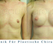 Brustvergrößerung - Bilder vor und nach der Operation - Beauty Group