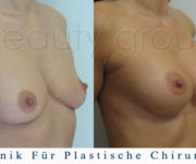 Brustvergrößerung - Bilder vor und nach der Operation - Beauty Group