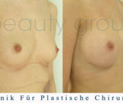 Brustvergrößerung - Bilder vor und nach der Operation - Beauty Group