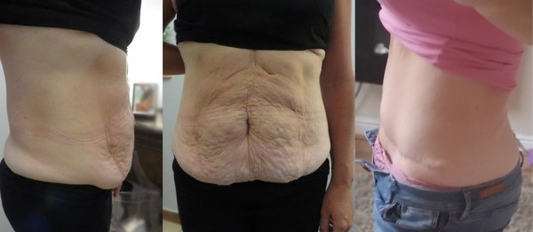 Abdominoplastik - Bilder vor und nach der Operation