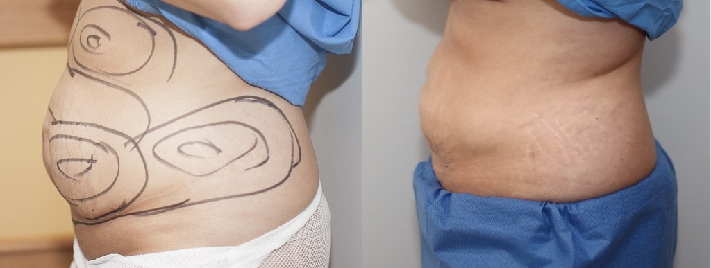 vor und nach der Fettabsaugung