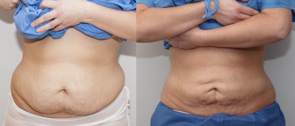 vor und nach der Fettabsaugung - vorne